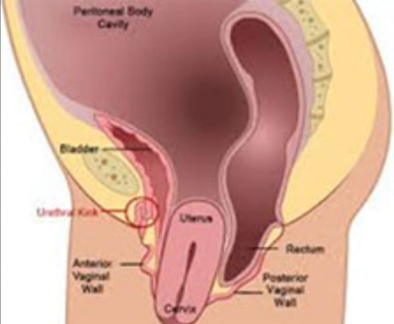 Mengenai Prolapsus Uteri Turun Berok Beritalima Com