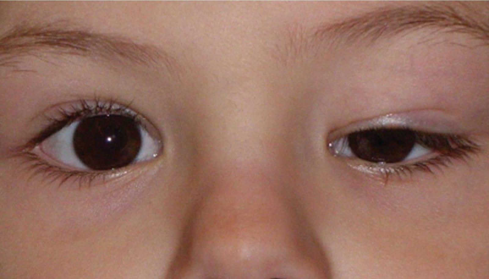 Один глаз открыт другой закрыт. Врожденный блефароптоз. Птоз век офтальмология.